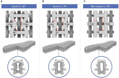 Efficacy of auxetic lattice structured shoe sole in advancing footwear comfort—From the perspective of plantar pressure and contact area
